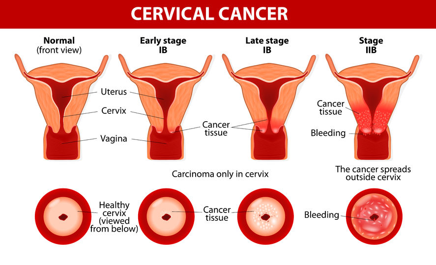 Le cancer cervical